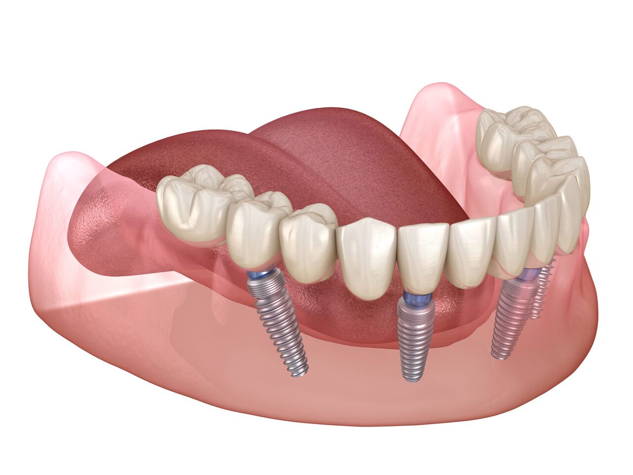 Dental Implants: All-on-4 Method