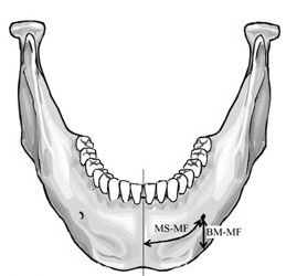 Dental Implants: All-on-4 Method