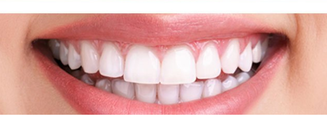 Laser Teeth Whitening at the Dental Office