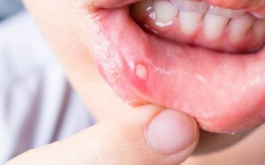 The Main Oral Diseases