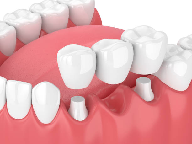 All-Ceramic Crowns