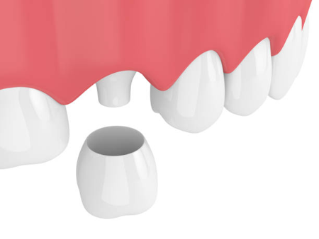 All-Ceramic Crowns
