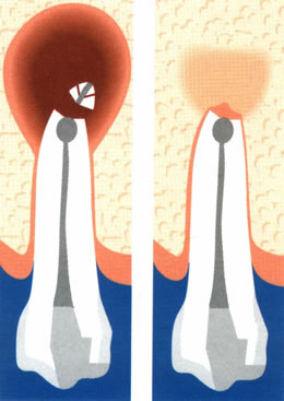 Apicoectomies