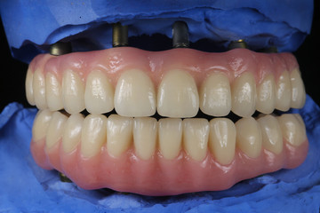 Full-mouth restoration with implants