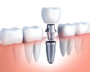Immediate Loading Implants