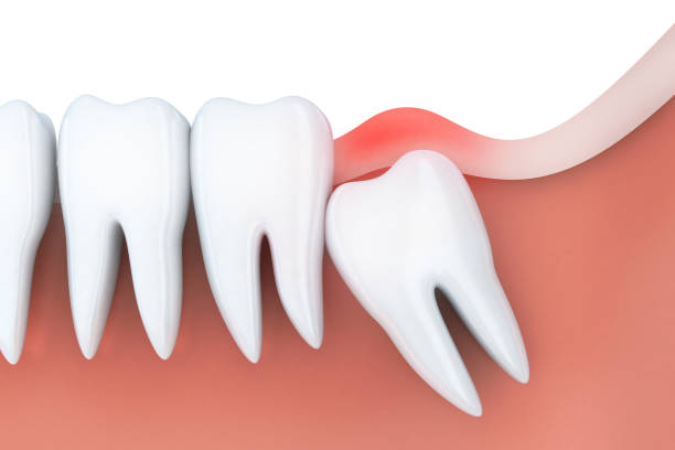Impacted Wisdom Teeth