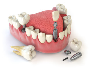 Implants for Multiple Teeth