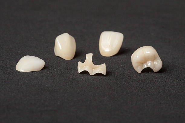 Inlays – IPS e.max
