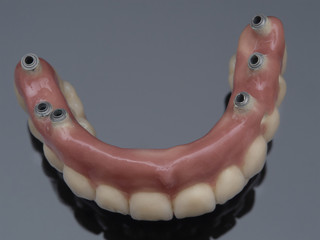 Overdenture on Implants