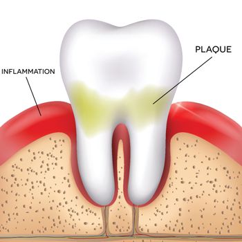 Periodontal Treatment