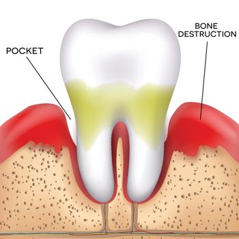 Periodontal Treatment