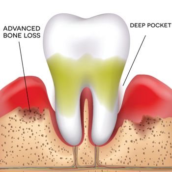 Periodontal Treatment
