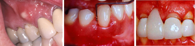 Periodontal Treatment