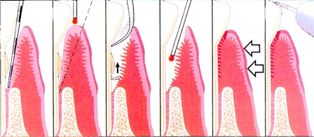 Periodontal Treatment
