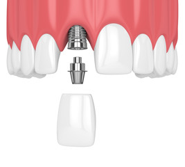 Single Tooth Implant